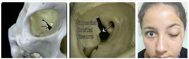 Superior Orbital Fissure Syndrome