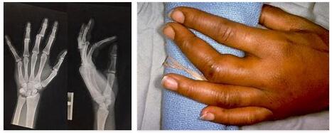 About Dislocated Finger