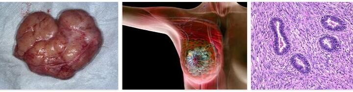 About Benign Breast Tumors
